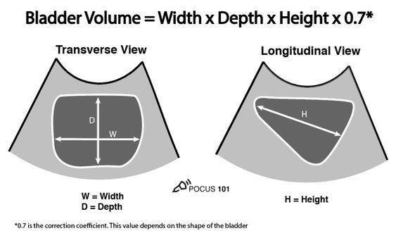 Bladder Volume #ultrasound 
#sonologist