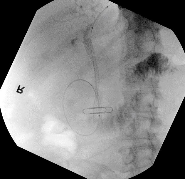 Failed ERCP due to inability to reach major papilla from tumor infiltration into duodenum. Tumor prohibited CDS placement in bulb. Pt declined PTBD and elected for attempt at antegrade biliary stent placement via EUS over HGS. After needle puncture and wire placement we entered