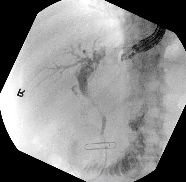 BaystateAdvEndo's tweet photo. Failed ERCP due to inability to reach major papilla from tumor infiltration into duodenum. Tumor prohibited CDS placement in bulb. Pt declined PTBD and elected for attempt at antegrade biliary stent placement via EUS over HGS. After needle puncture and wire placement we entered the biliary system with a @bostonsci needleknife sphincterotome, performed segmental dilation, and deployed an uncovered sems successfully. @BaystateGI @kais_zakharia @nha_duongDO #GITwitter