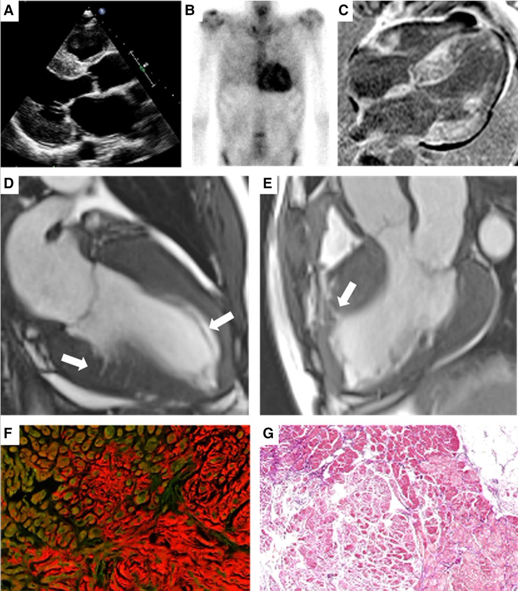 Beyond hypertrophy: unmasking sarcomeric hypertrophic cardiomyopathy in a patient with wild-type #ATTRAmyloidosis <a href="/EHJCVIEiC/">EHJCVI Editor-in-Chief</a> 
Anne J Koppelaar et al. ☑️doi.org/10.1093/ehjci/…
<a href="/EHJIMPEiC/">EHJ-IMP Editor-in-Chief</a> <a href="/JGrapsa/">Julia Grapsa MD, PhD</a> <a href="/ecocardio_cl/">Julián Vega Adauy</a> <a href="/iamritu/">Ritu Thamman MD</a> <a href="/Sarah_Moharem/">Sarah Moharem Elgamal, MBBCh, MSc, PhD👩🏻‍⚕️🫀</a> <a href="/SilCastelletti/">Silvia Castelletti</a> <a href="/EZancanaroMD/">Edoardo Zancanaro MD</a> <a href="/esrakaya_dr/">Esra Kaya</a>