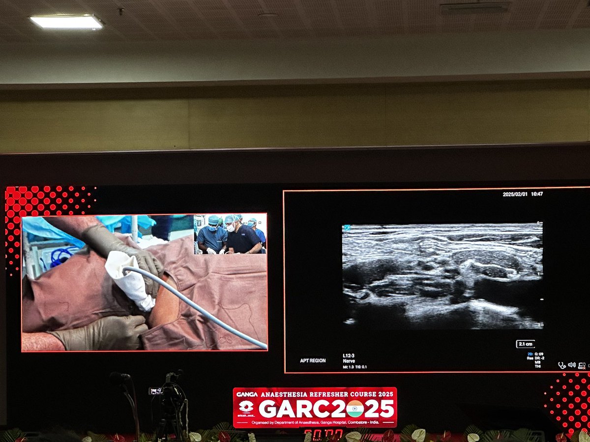 Shilpa Bhat (@shilpabhat04) on Twitter photo The live demonstration of SCUT and anterior axillary nerve block by the stalwart of RA, Dr Sandeep Diwan , was a masterclass! His beautiful visualization of LPN and AAN, along with his expert technique, left the audience in awe. A session packed with insights! #GARC25
<a href="/AoraIndia/">AORA India</a> The live demonstration of SCUT and anterior axillary nerve block by the stalwart of RA, Dr Sandeep Diwan , was a masterclass! His beautiful visualization of LPN and AAN, along with his expert technique, left the audience in awe. A session packed with insights! #GARC25
<a href="/AoraIndia/">AORA India</a>