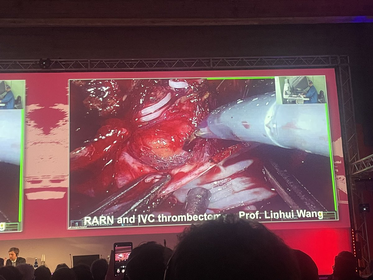 José Alberto Pereira (@josealpereira) on Twitter photo Just wrapped up an incredible experience at the 13th Techno Urology Meeting in Turin! 🚀
A truly inspiring congress showcasing cutting-edge surgical techniques and innovative advancements in Urology. 
Hope to be back next year! #TUM25 Just wrapped up an incredible experience at the 13th Techno Urology Meeting in Turin! 🚀
A truly inspiring congress showcasing cutting-edge surgical techniques and innovative advancements in Urology. 
Hope to be back next year! #TUM25