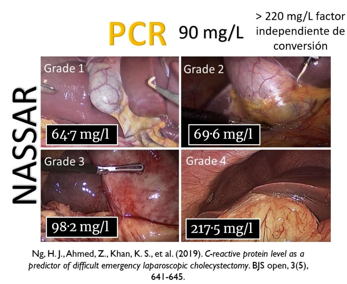 Niveles de proteína C reactiva en colecistitis aguda como predictor de una colecistectomia difícil.