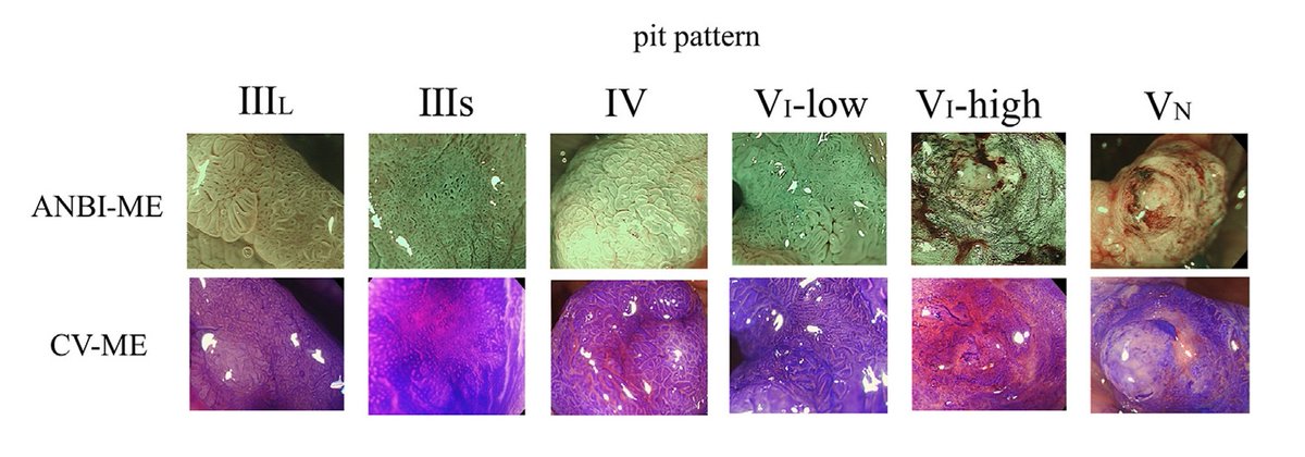 ✋¿Cada vez más problemas para conseguir violeta de genciana (VG) que te ayude a hacer el diagnóstico óptico con magnificación?
🖌️¿Has probado Acético-NBI?
Echa una visual a este DOI: 10.1016/j.gie.2024.10.060 via <a href="/GIE_Journal/">GIE</a>