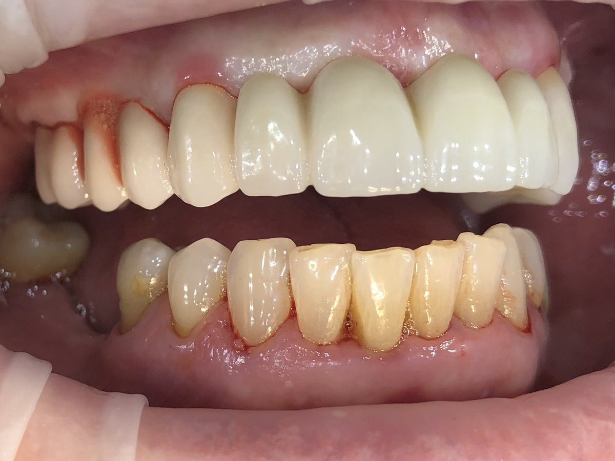 Before and After

Missing, loose and crumbling teeth replaced with a new fixed, solid, Zirconia Bridge. A new smile for a new year. 

Boom! 💥 

#crownandbridge #cosmeticdentistry #smilemakeover #smiledesign