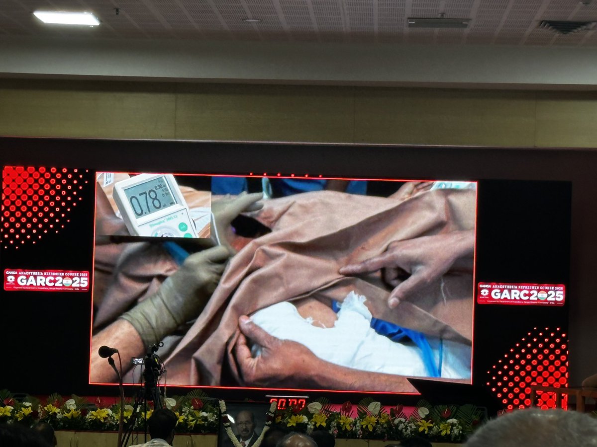 Shilpa Bhat (@shilpabhat04) on Twitter photo Such a thrilling experience to watch the maestro <a href="/BalavenkatSubr1/">Balavenkat Subramanian</a> himself perform the live demonstration of PNS-guided ISB! Every move was a masterclass in precision and expertise.
<a href="/ManshadShowkat1/">Manshad Showkath</a> <a href="/tsmurali/">Murali Thondebhavi</a> <a href="/AoraIndia/">AORA India</a> <a href="/anesthetix/">Amjad Maniar</a> <a href="/vedhika_shanker/">Vedhika shanker</a> <a href="/DrRiteshRoy1/">Prof Dr Ritesh Roy</a> <a href="/DrDiveshArora/">Divesh Arora</a> Such a thrilling experience to watch the maestro <a href="/BalavenkatSubr1/">Balavenkat Subramanian</a> himself perform the live demonstration of PNS-guided ISB! Every move was a masterclass in precision and expertise.
<a href="/ManshadShowkat1/">Manshad Showkath</a> <a href="/tsmurali/">Murali Thondebhavi</a> <a href="/AoraIndia/">AORA India</a> <a href="/anesthetix/">Amjad Maniar</a> <a href="/vedhika_shanker/">Vedhika shanker</a> <a href="/DrRiteshRoy1/">Prof Dr Ritesh Roy</a> <a href="/DrDiveshArora/">Divesh Arora</a>