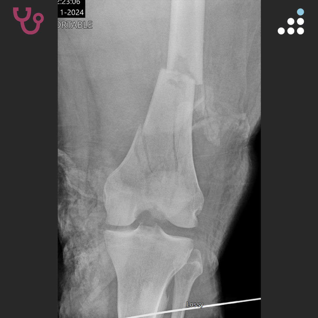 Here is a new case by Dr. Michael Beltran and <a href="/uc_health/">UC Health</a>.

LOWER EXTREMITY POLYTRAUMA WITH IPSILATERAL FEMORAL NECK AND SHAFT FX IN 50M

This case will be debated at Evolving Concepts in Orthopaedic Trauma <a href="/FOREonline/">FORE</a> in Park City, UT, Apr 4-6, 2025.

How would you manage this