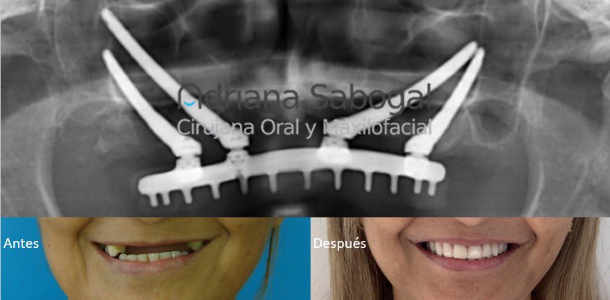 Adrisabogal09's tweet photo. IMPLANTES CIGOMÁTICOS: DIENTES FIJOS

Editora del Libro: Atlas de Implantes Cigomáticos. Autores: César Guerrero, Adriana Sabogal
Con estos dientes fijos no solo se recupera la capacidad de masticar con seguridad sino que, también, se recupera la estética facial. https://t.co/zV1Cl3rEuz