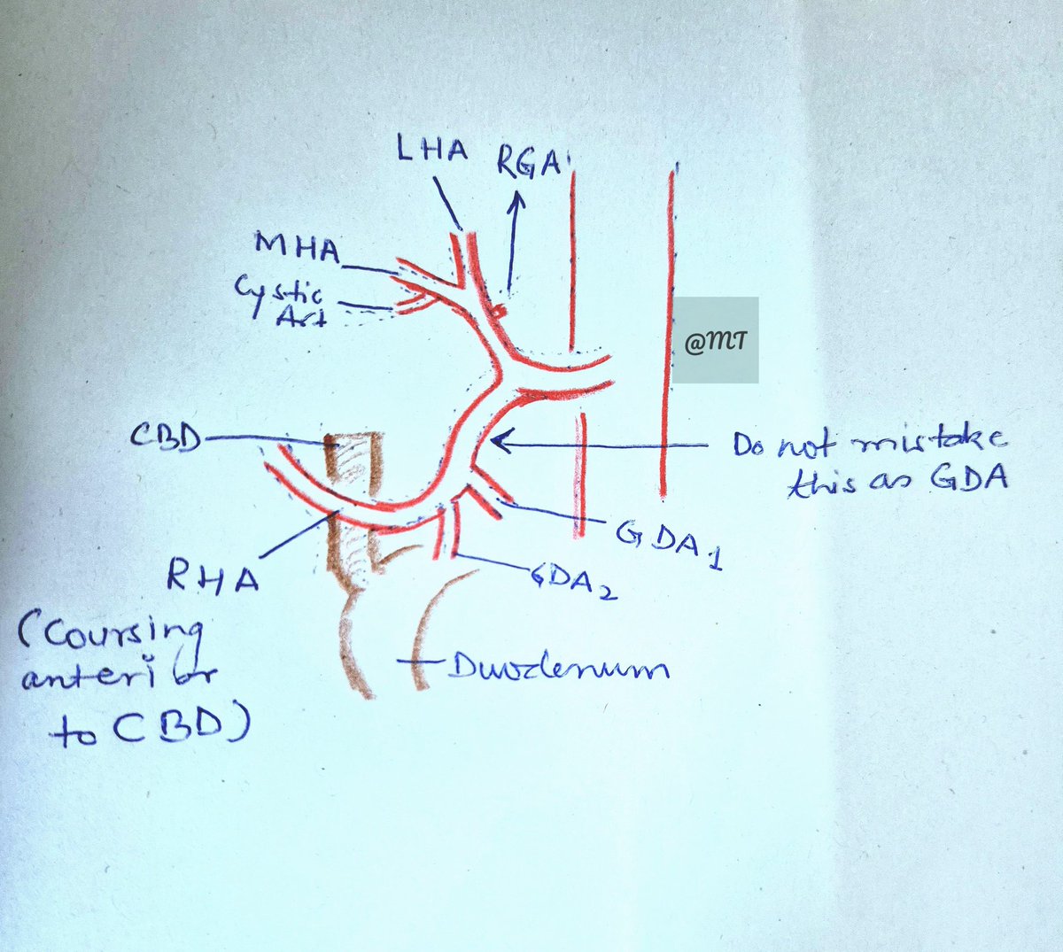 Saturday challenge - Anatomy varies, precision remains...
<a href="/IHPBA/">IHPBA</a> <a href="/EAHPBA/">E-AHPBA</a> <a href="/AHPBA/">AHPBA</a>