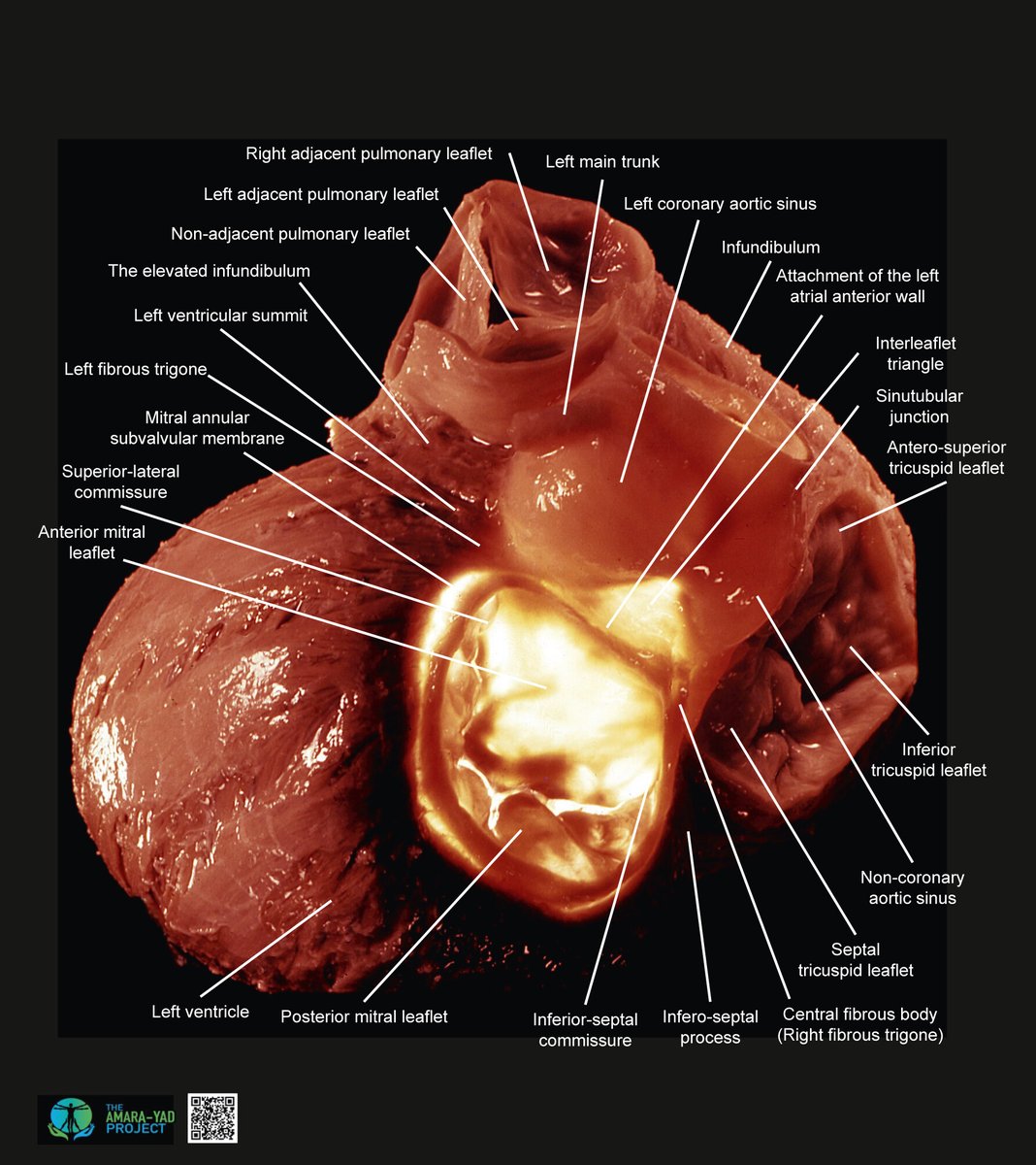 JACC Journals (@jaccjournals) on Twitter photo Through the amazing Amara Yad project, see incredible anatomic detail of cardiac structures – this week it’s the anatomy of the mitral and aortic valve continuity: jacc.org/doi/10.1016/j.…
#JACC <a href="/shivkumarmd/">Kalyanam Shivkumar MD PhD</a> Through the amazing Amara Yad project, see incredible anatomic detail of cardiac structures – this week it’s the anatomy of the mitral and aortic valve continuity: jacc.org/doi/10.1016/j.…
#JACC <a href="/shivkumarmd/">Kalyanam Shivkumar MD PhD</a>