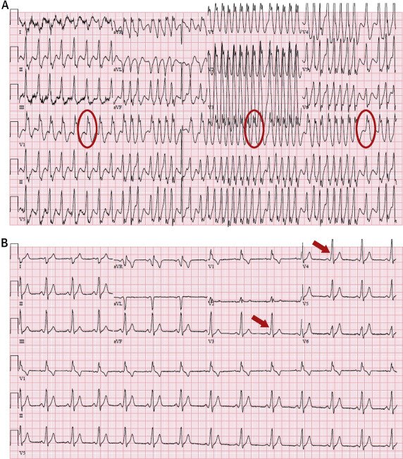 In pre-excited Atrial Fibrillation 
DO NOT
 give anything that blocks conduction at AV node (including calcium channel blockers, adenosine or digoxin) as this can cause ventricular tachycardia.

If haemodynamically stable = Procainamide 

If Unstable = Cardioversion