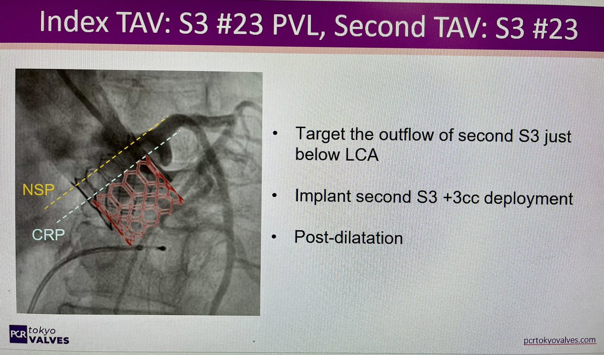 Miho.Fukui (@miho_fukui_) on Twitter photo Wanna to learn how to systematically assess the feasibility of Redo TAV and how to optimize the procedure?
Come join us! Feb 8th 13:40- at #PCRTokyoValves <a href="/PCRonline/">PCRonline 🫀</a> <a href="/OhnoTuri/">Yohei Turi Ohno</a> <a href="/misako_desu/">Misako TOKI</a> <a href="/bapat_savrtavr/">vinayak bapat</a> <a href="/TomokiOchiai/">Tomoki Ochiai</a> <a href="/MHIF_Heart/">Minneapolis Heart Institute Foundation</a> <a href="/drtsakamoto/">Tomohiro SAKAMOTO, MD, PhD</a> Wanna to learn how to systematically assess the feasibility of Redo TAV and how to optimize the procedure?
Come join us! Feb 8th 13:40- at #PCRTokyoValves <a href="/PCRonline/">PCRonline 🫀</a> <a href="/OhnoTuri/">Yohei Turi Ohno</a> <a href="/misako_desu/">Misako TOKI</a> <a href="/bapat_savrtavr/">vinayak bapat</a> <a href="/TomokiOchiai/">Tomoki Ochiai</a> <a href="/MHIF_Heart/">Minneapolis Heart Institute Foundation</a> <a href="/drtsakamoto/">Tomohiro SAKAMOTO, MD, PhD</a>