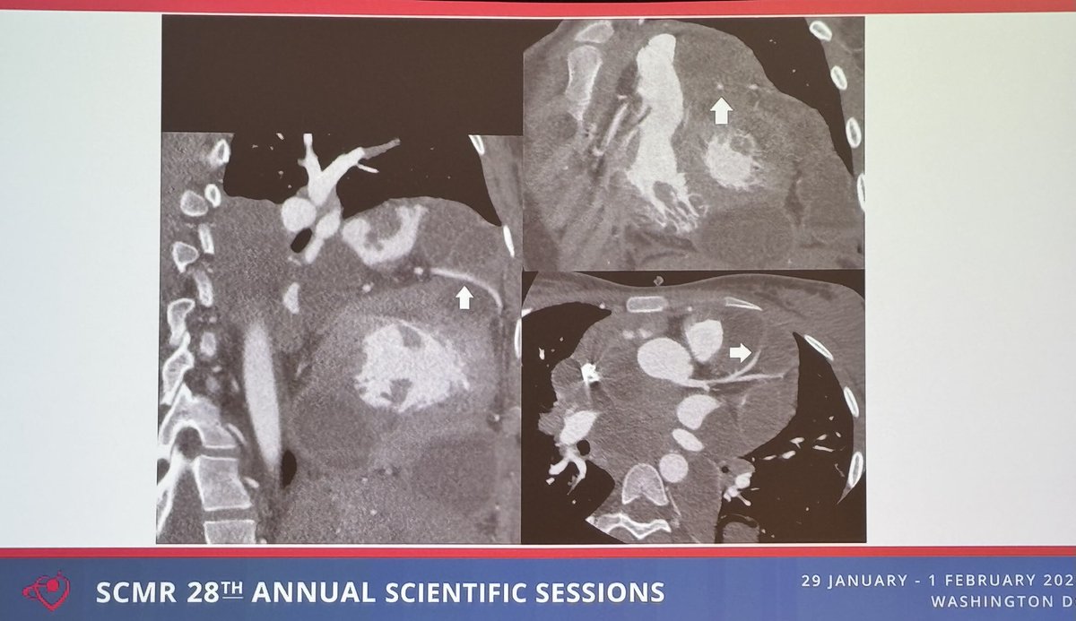 I am so grateful for those who traveled so far to #SCMR2025

Pictured is Dr. Mekkaoui Abderrahmane <a href="/mekAbdou260/">Mekkaoui Abderrahmane</a>.

He presented a case all the way from Algeria (little to no cardiac MRI access) of Multiple Cardiac Hydatid Cysts. #WhyCMR