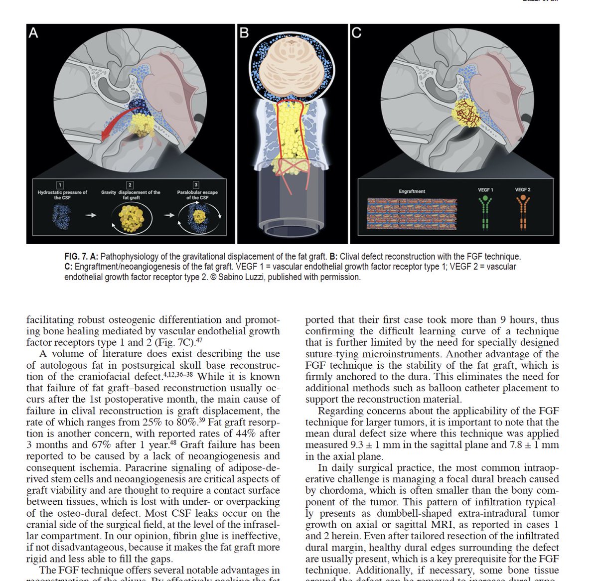 meGursesmd's tweet photo. I am pleased to share our recent publication in Neurosurgical Focus: Clival Dural Reconstruction via Transnasal Approaches: Fat Graft Fixation Technique. #Neurosurgery #SkullBaseSurgery #CSFFistula #Chordoma #neuro #DuralReconstruction #oncology #NeurosurgicalResearch #neuro https://t.co/PSqadhapb6