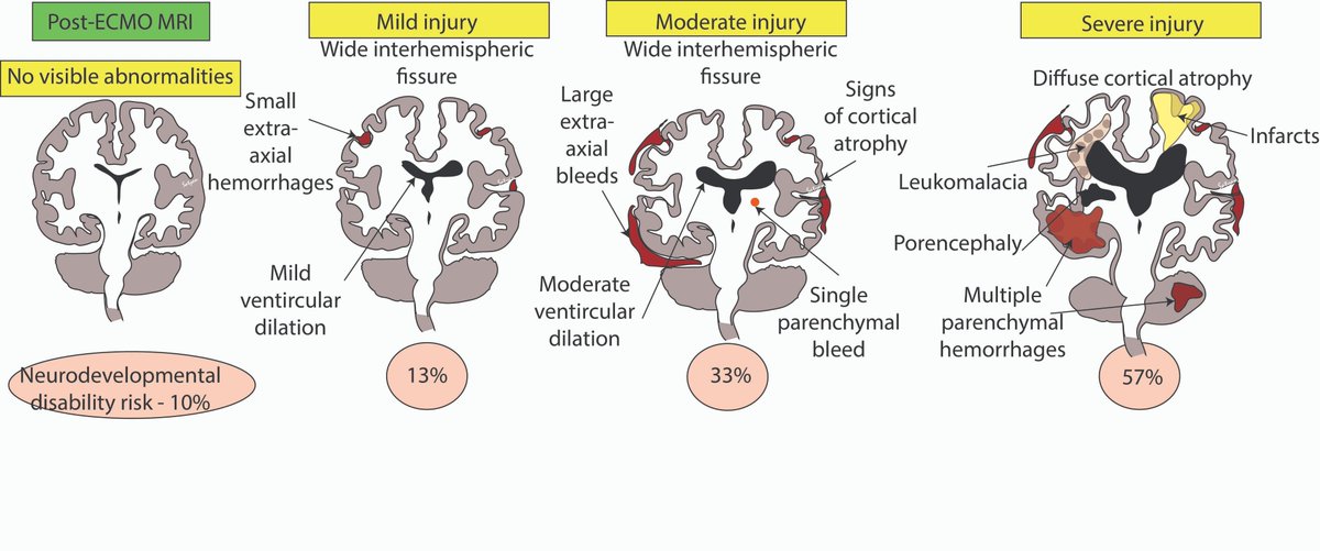 Satyan (@neosatyan) on Twitter photo #neotwitter - this week's #neographic - long term changes in brain to help parents (and trainees understand) following #ECMO <a href="/PedPeriClinics/">Pediatric Clinics</a> <a href="/AAPneonatal/">AAP Neonatal</a> <a href="/WomenNeo/">Women In Neonatology</a> <a href="/NewbornBrains/">Newborn Brain Society</a> sciencedirect.com/science/articl… by <a href="/SankaranDeepika/">Deepika Sankaran</a> Emily Stieren Cath Rottkamp <a href="/UCDavisChildren/">UCDavisChildrensHosp</a> <a href="/HopeforHIE/">Hope for HIE ☀️</a> #neotwitter - this week's #neographic - long term changes in brain to help parents (and trainees understand) following #ECMO <a href="/PedPeriClinics/">Pediatric Clinics</a> <a href="/AAPneonatal/">AAP Neonatal</a> <a href="/WomenNeo/">Women In Neonatology</a> <a href="/NewbornBrains/">Newborn Brain Society</a> sciencedirect.com/science/articl… by <a href="/SankaranDeepika/">Deepika Sankaran</a> Emily Stieren Cath Rottkamp <a href="/UCDavisChildren/">UCDavisChildrensHosp</a> <a href="/HopeforHIE/">Hope for HIE ☀️</a>