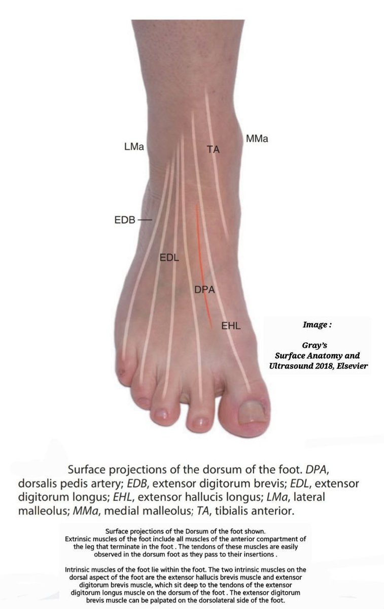 TENDONS SURFACE ANATOMY: DORSUM OF FOOT Tendons of EXTRINSIC muscles of  foot observed in the dorsum foot. The two INTRINSIC muscles on dorsal  aspect of foot are extensor hallucis brevis \u0026 extensor, image size:757x1200