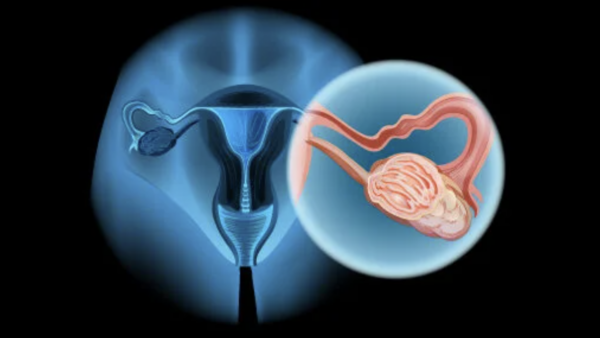 oncodaily's tweet image. Randomized phase III trial of adjuvant carboplatin and paclitaxel in epithelial ovarian cancer
@tuttsakhil 

oncodaily.com/science/random…

#OvarianCancer #EOC #Cancer #OncoDaily #MedEd #MedX #MedNews #Medicine #Oncology