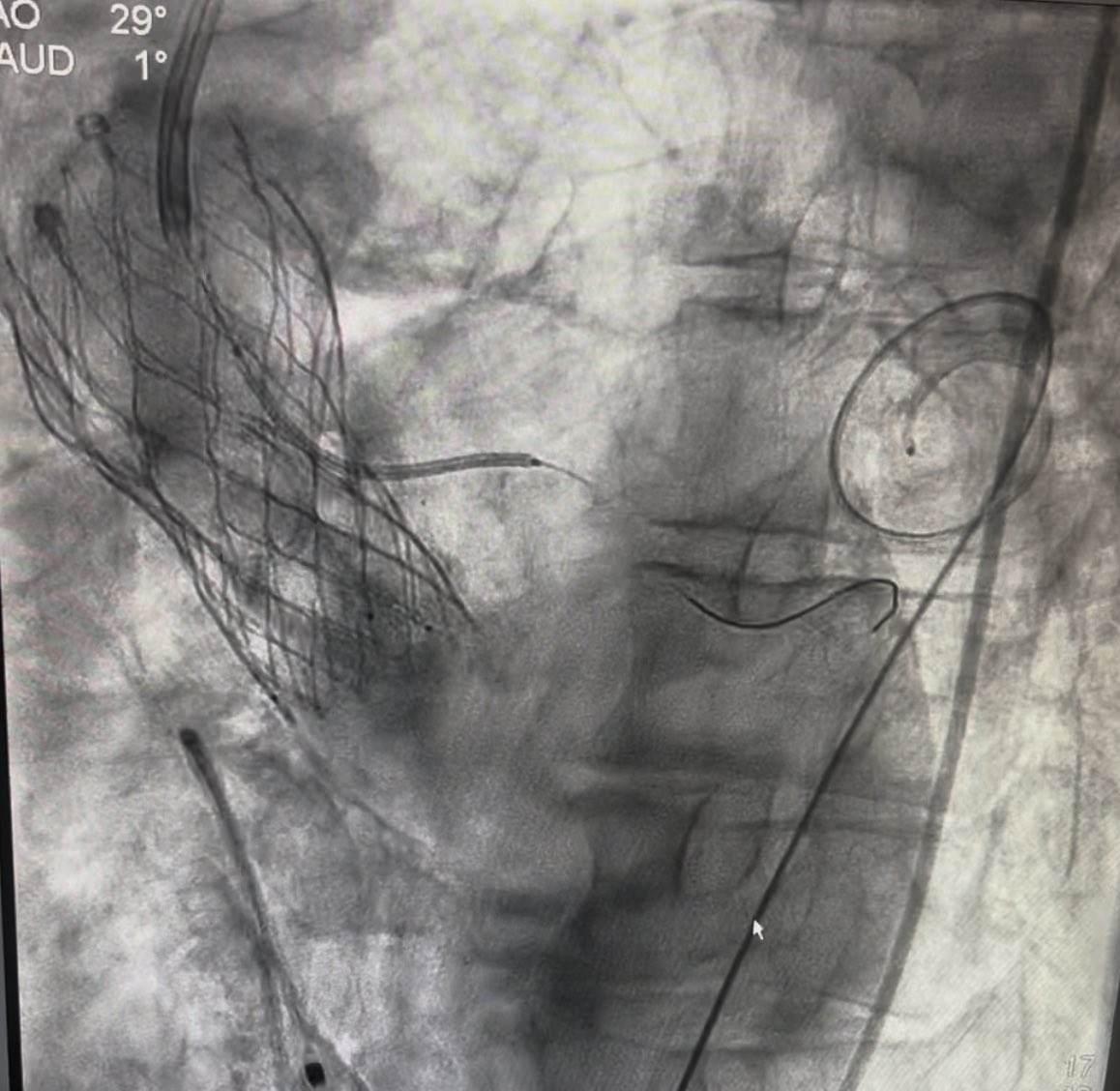 Abdelkader Almanfi, MD, FACC, FSCAI (@almanfi_cardio) on Twitter photo Glad to help my colleagues in Austin Texas by proctoring such a high risk TAVR case.
Pt with small annulus, small sinuses & low coronary height, high risk for LM occlusion & patient prosthesis mismatch.
We used <a href="/Dasisimulations/">DASI Simulations LLC</a> AI for risk assessment!
We did native left Glad to help my colleagues in Austin Texas by proctoring such a high risk TAVR case.
Pt with small annulus, small sinuses & low coronary height, high risk for LM occlusion & patient prosthesis mismatch.
We used <a href="/Dasisimulations/">DASI Simulations LLC</a> AI for risk assessment!
We did native left