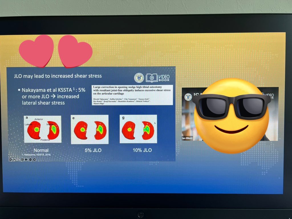 hiroshi0273's tweet photo. Thank you so much for citing our papers🦵
@ISAKOS
#doublelevelosteotomy
#isakos
#2025年
#arthroscoicbeltcapsulodesis
#内側半月板逸脱
#abc法
#半月板制動術 https://t.co/fLxJLsUTnk