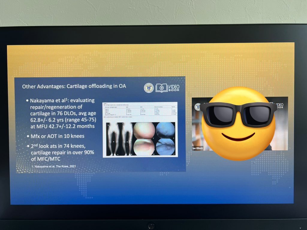 hiroshi0273's tweet photo. Thank you so much for citing our papers🦵
@ISAKOS
#doublelevelosteotomy
#isakos
#2025年
#arthroscoicbeltcapsulodesis
#内側半月板逸脱
#abc法
#半月板制動術 https://t.co/fLxJLsUTnk