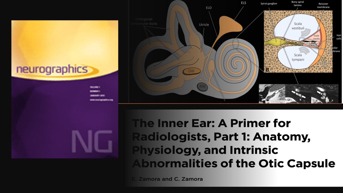 UNC Neuroradiology (@unc_neurorads) on Twitter photo โจ Let's Dive Into the Inner Ear! ๐
Check out "The Inner Ear: A Primer for Radiologists" by Drs. Zamora in Neurographics!
This review covers inner ear anatomy, physiology, and otic capsule abnormalities, packed with key imaging pearls and beautiful illustrations. โจ Let's Dive Into the Inner Ear! ๐
Check out "The Inner Ear: A Primer for Radiologists" by Drs. Zamora in Neurographics!
This review covers inner ear anatomy, physiology, and otic capsule abnormalities, packed with key imaging pearls and beautiful illustrations.