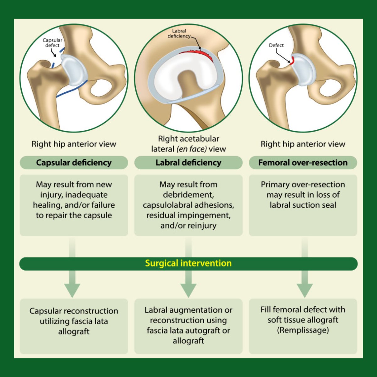 Arthroscopy Journal (@arthroscopyj) on Twitter photo New infographic drop! Dr. Mark Philippon and colleagues illustrate the hip arthroscopy terrible triad (AKA capsular deficiency, labral deficiency, and femoral over-resection) and their respective surgical management options #HipArthroscopy <a href="/marcphilippon/">Marc J. Philippon, MD</a>
ow.ly/vikr50UN0mM New infographic drop! Dr. Mark Philippon and colleagues illustrate the hip arthroscopy terrible triad (AKA capsular deficiency, labral deficiency, and femoral over-resection) and their respective surgical management options #HipArthroscopy <a href="/marcphilippon/">Marc J. Philippon, MD</a>
ow.ly/vikr50UN0mM