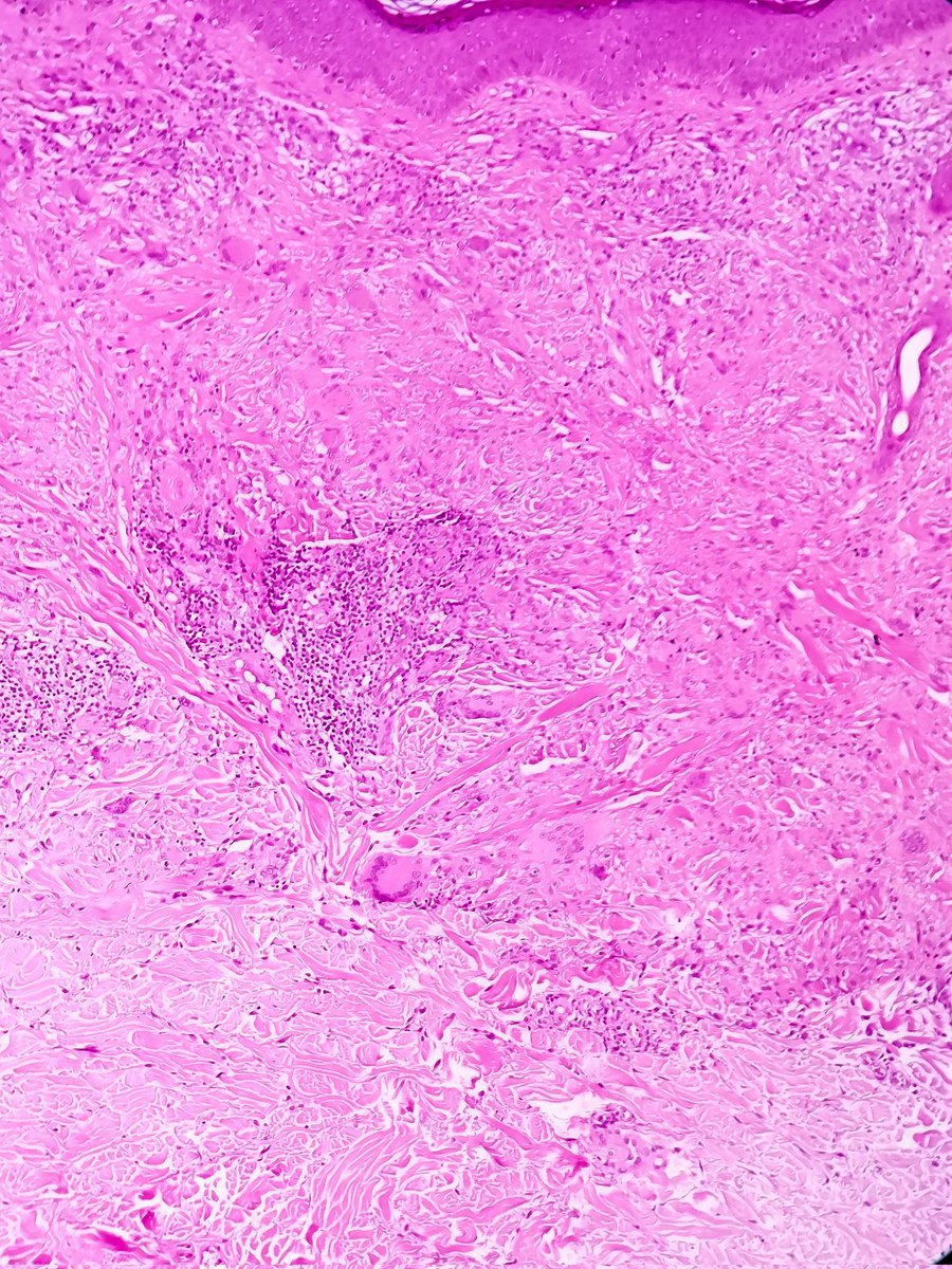 padmapathology1's tweet photo. #dermpath
#pathclassic
Granuloma annulare - 
🔬Degenerating collagen surrounded by lymphocytes, palisading histiocytes and occasional multinucleate giant cells. https://t.co/wFWmxDqgeq