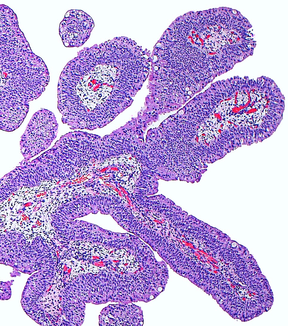 ziad_zaatari's tweet photo. 🔬 Urothelial Papilloma ~ Thin "finger-like" papillae (left picture) lined by normal urothelium (right picture) ~ #GUpath #BeautyInTheBenign #Pathology #Urology https://t.co/F7yeJSeKdG