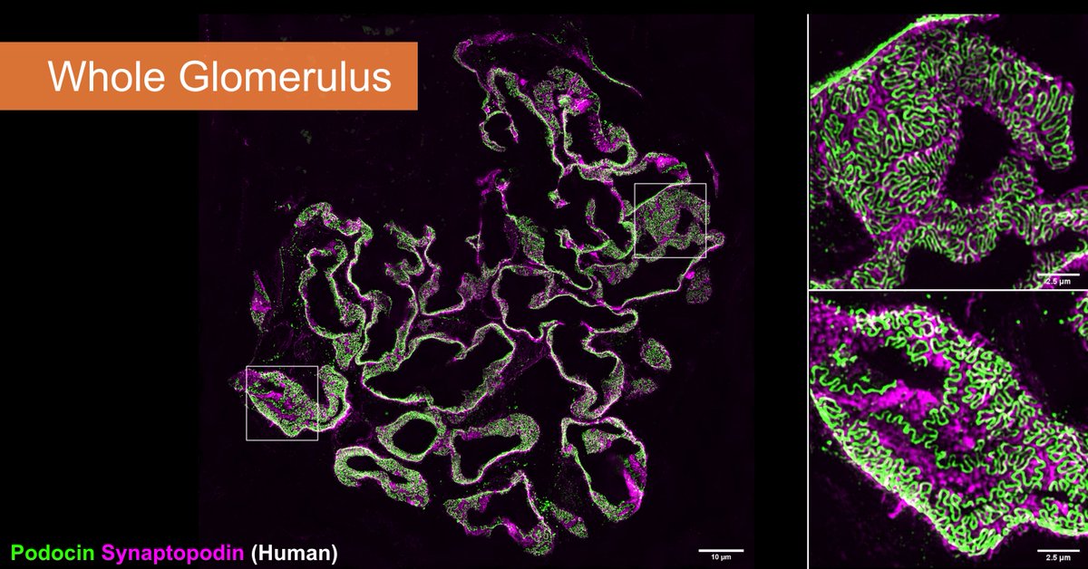 🚀 I’m thrilled to announce that our review, "A New Era in Nephrology: The Role of Super-Resolution Microscopy in Research, Medical Diagnostics, and Drug Discovery," will soon be published in "Kidney International"! 🚀
This paper highlights the game-changing potential of 3D-super