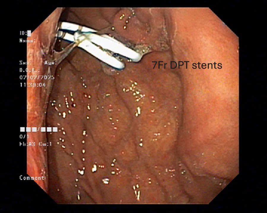 Case of acute necrotising pancreatitis with infected walled off necrosis, successfully managed with EUS guided cystogastrostomy using plastic stents
@ Jagruth multispeciality hospital
# Khammam