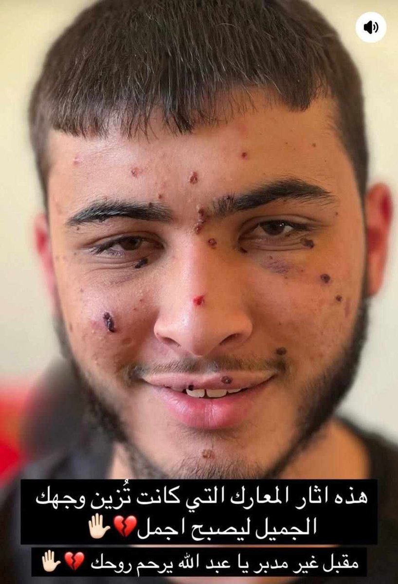 هكذا بدا الشهيد عبد الهادي علاونة بعد إصابة سابقة له

تحرر بصفقة شهر 11 عام 2023 مع فئة الأطفال وانضم فور إطلاق سراحه للمقاومة في بلدته قباطية، ومنذ ذلك الحين حتى ارتقائه مساء أمس وهو في ساحات الوغى، رحمه الله وتقبله في عليين.