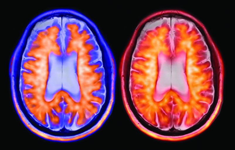 Another exciting milestone was reached this week in the #Alzheimer’s disease landscape!

👉𝗧𝗵𝗲 𝗯𝗶𝗴 𝗻𝗲𝘄𝘀: 

On Jan 26, 2025, <a href="/EisaiUS/">Eisai US</a> and <a href="/biogen/">Biogen</a> announced <a href="/FDA/">FDA</a> approval of IV maintenance dosing of once every 4 weeks for #lecanemab. For #AD maintenance therapy, once a