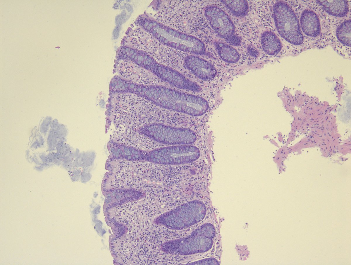 MirunaPopescu13's tweet image. #GIPath quiz for the weekend. This is a GI manifestation of a systemic disease.
Q1: What's the diagnosis?
Q2: What's the stain (image 3)?
Q3: What's a good indirect sign of this diagnosis?

#PathTwitter #pathresidents #pathfellows