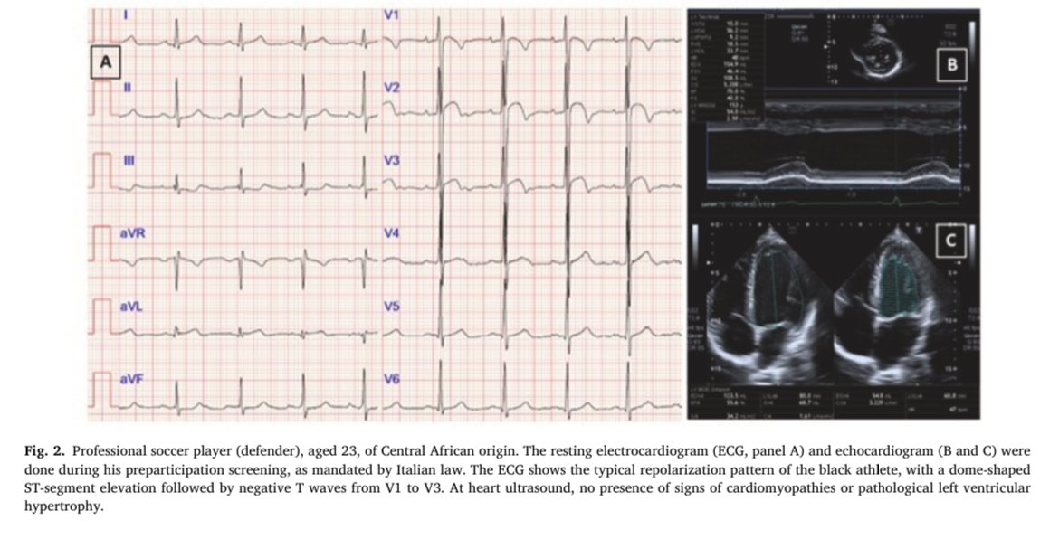 🔴 Interpretation &amp; management of T wave inversion in athletes: An expert opinion statement #Cardiology #CardioEd #SportCardiology <a href="/SICSPORT1/">SICSPORT</a> <a href="/SIC_CARDIOLOGIA/">SIC Società Italiana di Cardiologia</a>