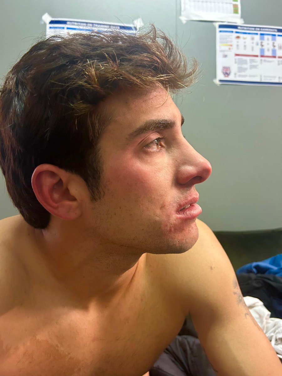 Así quedó el ojo de Cristian Garin.