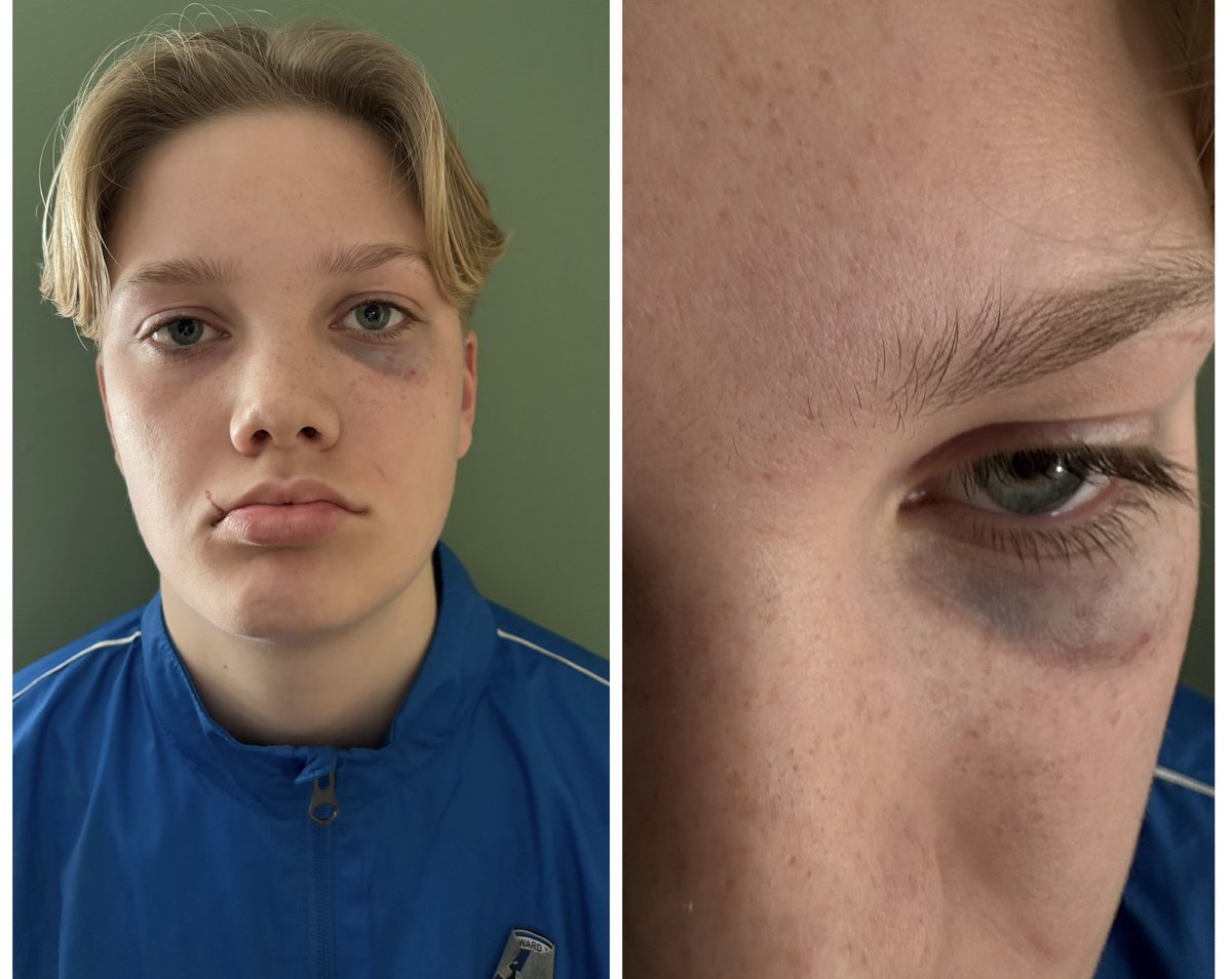 DanielCroxson's tweet photo. @fa Appalling scenes during @YouthRochester’s U15 MDYL Div 1 game v Medway United East today. Medway player repeatedly punched, including as player restrained him. Facial injuries sustained, and he was sent off! Laws 12 and E20.1 broken, and the red card should be rescinded. https://t.co/Z4eg7SL6CA