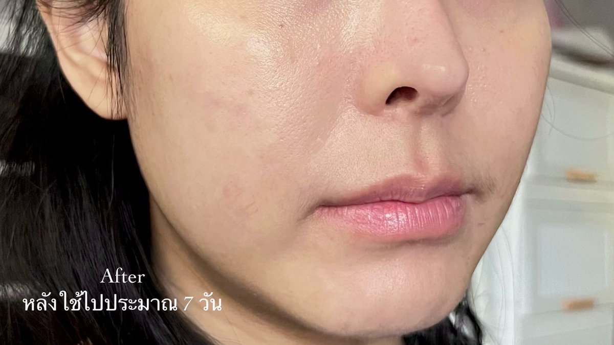 ให้นี่เป็น hero item ของคนเป็นสิวซ้ำซาก/สิวฮอร์โมนแบบเรา มาจบที่เซรั่มยูเซอริน Pro Acne Solution ช่วยทั้งลดสิวและรอยสิวเลย ใช้เซรั่มเดี่ยวๆก็เห็นผลมากแล้วดี พอมาใช้คู่กับเจลโฟม รู้สึกหายไวขึ้นอีก สิวยุบไว รอยสิวดีขึ้น ไม่เห่อและหน้าเนียน ไม่แห้งไม่ลอก ไม่แรงเหมือนใช้ยาแต้มแบบที่เคยใช้ แนะนำให้ลงทุนคู่นี้คับ หายจริง #EucerinThailand #จบทุกสิวและรอยสิวซ้ำซาก #EucerinTripleEffectSerum #EucerinGelToFoam