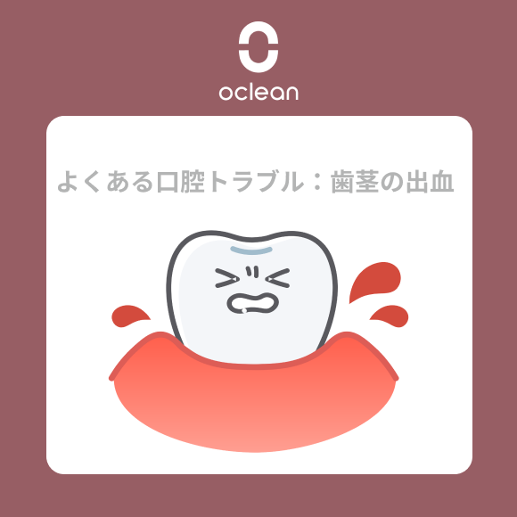 Oclean_JP's tweet photo. よくある口腔トラブル：歯茎の出血

😥歯茎の出血は、細菌感染による炎症が原因で、
歯磨き時に出血することがあります。
😥また、力を入れすぎて歯を磨いたり、硬い毛の
歯ブラシを使うと歯茎が傷つきやすいです。
😥ビタミンC不足も歯茎の出血を引き起こす原因です。

出血を放置すると、炎症が進行し、重度の歯周炎を
引き起こす可能性があります。
最終的には歯茎が後退し、歯がゆるんだり抜け落ちる
ことも…。☹️

対策：
❶定期的に歯科医院でクリーニングを受ける；
❷歯磨きは力を入れすぎず、優しく行う；
➌歯茎を刺激しない柔らかい毛の歯ブラシを使う；
➍ビタミンCを豊富に含む果物や野菜を摂取して、
歯茎の健康を保つ🦷✨

#口臭対策 #口腔健康 #口腔ケア #オーラルケア #歯周病 #電動歯ブラシ #ジェットウォッシャー #口腔洗浄器