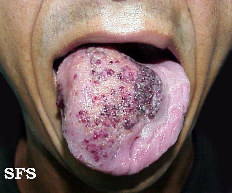<a href="/IhabFathiSulima/">Dr Ihab Suliman</a> Lymphangioma circumscriptum (LC) or microcystic lymphatic malformation is a hamartomatous malformation of the lymphatic channels of the skin. This benign ectasia has two components: (a) the clinically obvious, dermal vesicular component, and (b) the not-so-obvious deeper