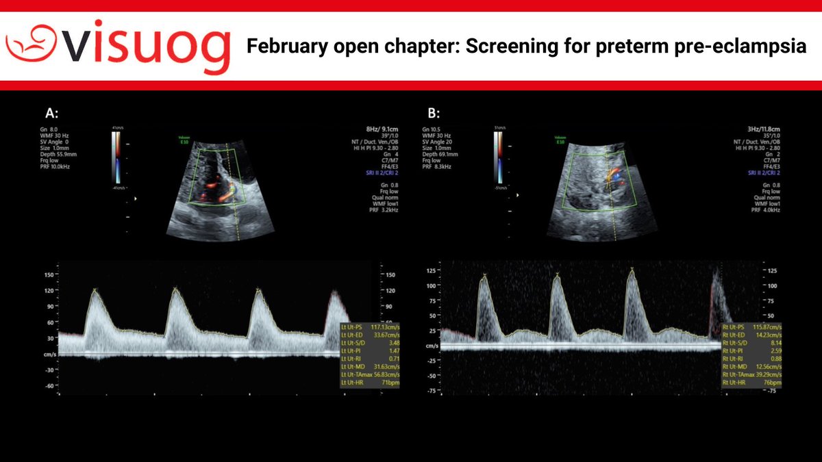 ISUOG's tweet photo. View the latest VISUOG open chapter: Screening for preterm pre-eclampsia  

February’s free #VISUOG open chapter is now available. This covers key information including incidence, pathogenesis and managing women with high-risk screening results. Within the chapter you will also find a patient information sheet for you to share with your patients. 

Find out more and access the chapter now: https://t.co/K4hcc8MUUh

#healtheducation #ISUOG #loveultrasound #OBGYN #patientcare