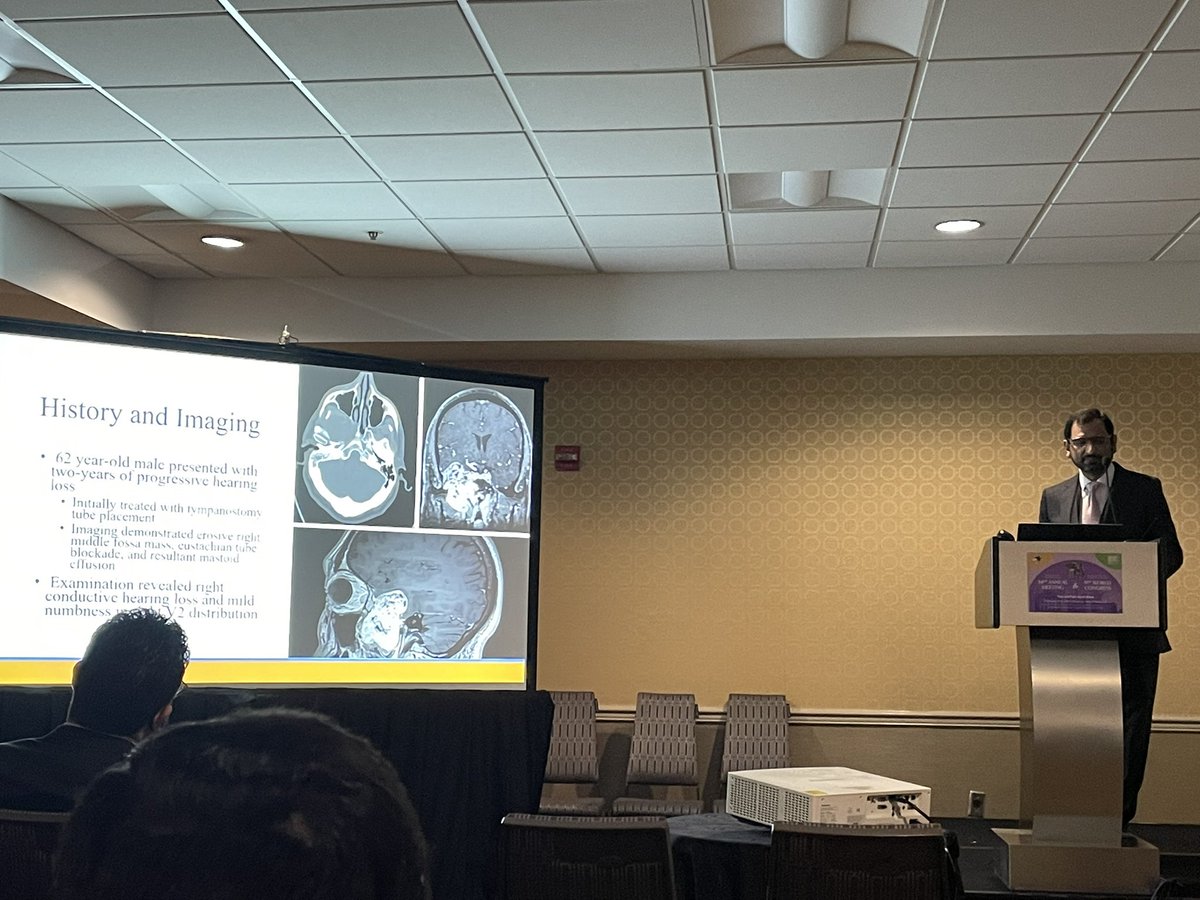 HannaAlgattasMD's tweet image. Great talk by Dr Waqas on our approach to a giant trigeminal schwannoma at NASBS - well done!