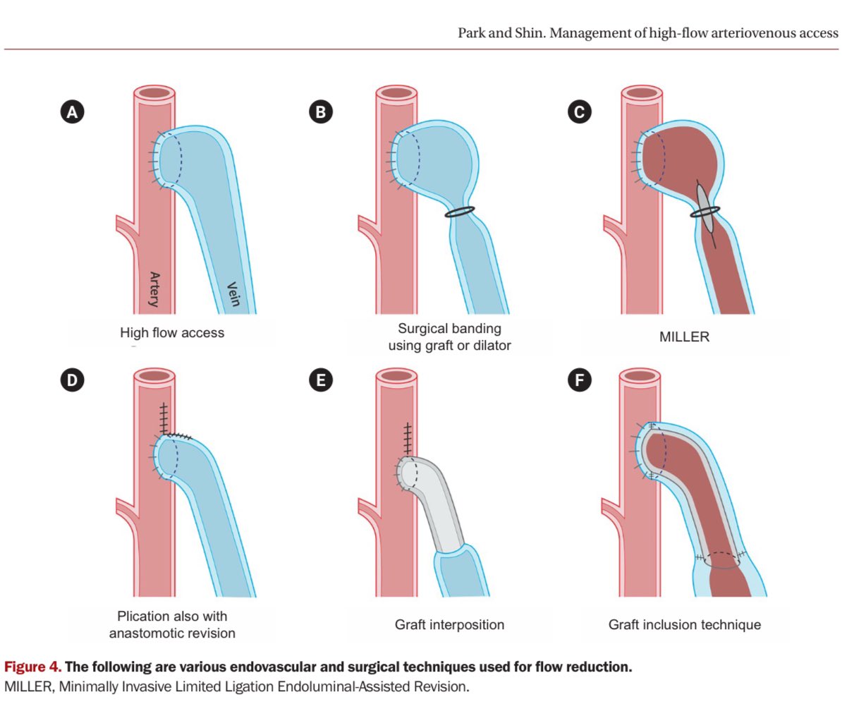 hardik4u24's tweet image. 🌟Managing High-Flow AV Access in #HD

🌊High-flow AV access (Qac &amp;gt;2L/min) can overload heart, causing high-output cardiac failure

🔑Early detection &amp;amp; flow reduction (banding, grafts) are key
🔑Monitor Qac &amp;amp; echo regularly

🆓doi.org/10.23876/j.krc…

#VascularAccess #NephX #MedX