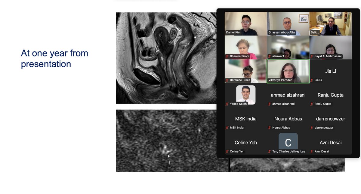 Ghassan Abou-Alfa (@gaboualfa) on Twitter photo Thanks <a href="/MSKCancerCenter/">Memorial Sloan Kettering Cancer Center</a> <a href="/MSK_DeptOfMed/">MSK Department of Medicine</a> Leonard Saltz on insightful discussion of rectal cancer case. <a href="/GABOUALFA/">Ghassan Abou-Alfa</a> 17th year of monthly fellows' based GI cancer case discussion. We sure learn the advances of care but strategic thinking is key. Medicine is an Art! Thanks <a href="/MSKCancerCenter/">Memorial Sloan Kettering Cancer Center</a> <a href="/MSK_DeptOfMed/">MSK Department of Medicine</a> Leonard Saltz on insightful discussion of rectal cancer case. <a href="/GABOUALFA/">Ghassan Abou-Alfa</a> 17th year of monthly fellows' based GI cancer case discussion. We sure learn the advances of care but strategic thinking is key. Medicine is an Art!
