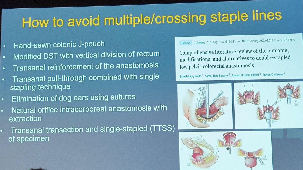 Harish_SurgOnc's tweet photo. #ColorectalSurgery #Stapling #Anastomosis #SurgicalSafety
#AnastomoticLeak #SurgicalInnovation #ColorectalSurgery
@SWexner @BoutrosMarylise @DCRjournal @escp_tweets @ASCRS_1 #ICDS25 #Some4surgery
#colorectal https://t.co/owWMQuwnfm