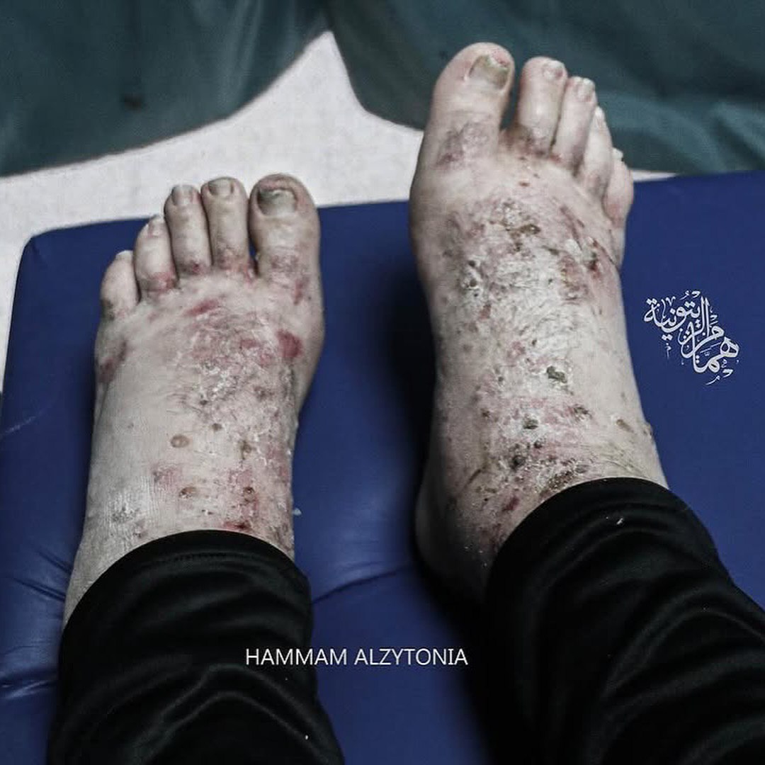 Les traces de torture sur le prisonnier Wael Jumaa du nord de Gaza, libéré aujourd'hui dans le cadre de l'accord d'échange de prisonniers.