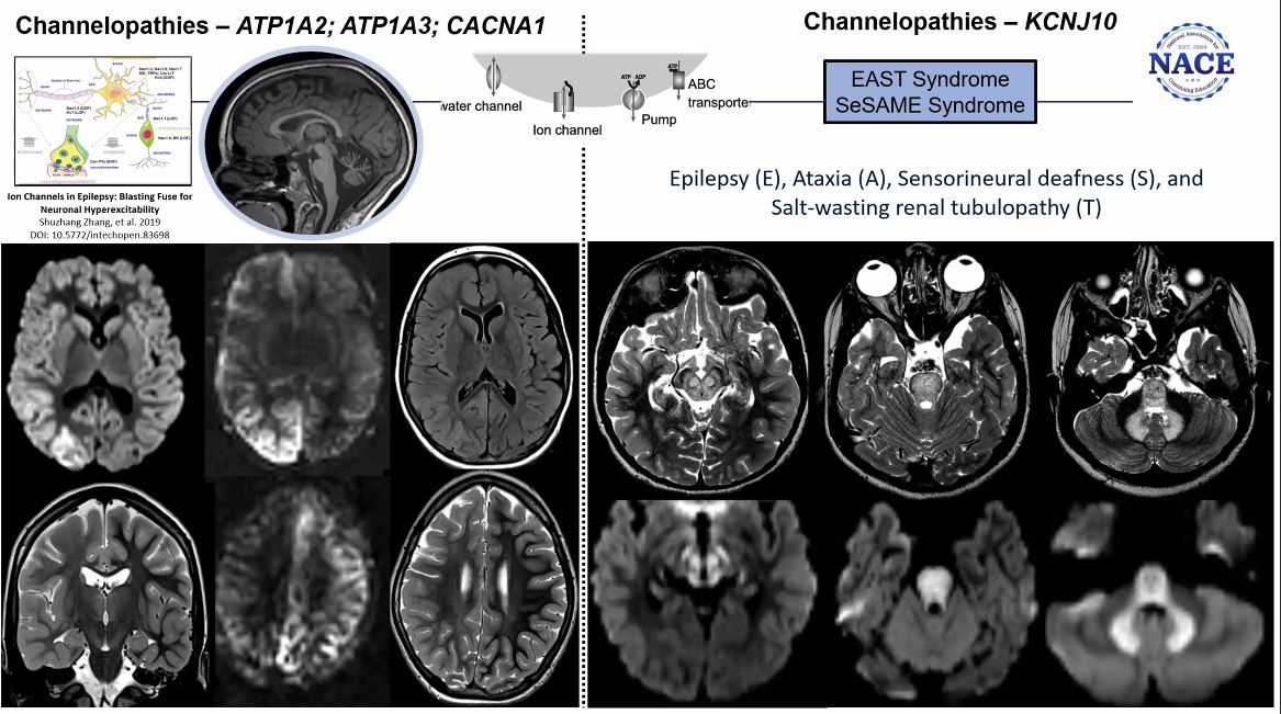American Society of Pediatric Neuroradiology (@the_aspnr) on Twitter photo Neuroimaging & Neuroclinical Practices in Metabolic Disorders - CME Webinar
We are off to a great start with <a href="/cesaralvesneuro/">CESAR ALVES</a> helping us gain a deeper understanding of the nuances of neurometabolic disorders! It's not too late to join! Neuroimaging & Neuroclinical Practices in Metabolic Disorders - CME Webinar
We are off to a great start with <a href="/cesaralvesneuro/">CESAR ALVES</a> helping us gain a deeper understanding of the nuances of neurometabolic disorders! It's not too late to join!