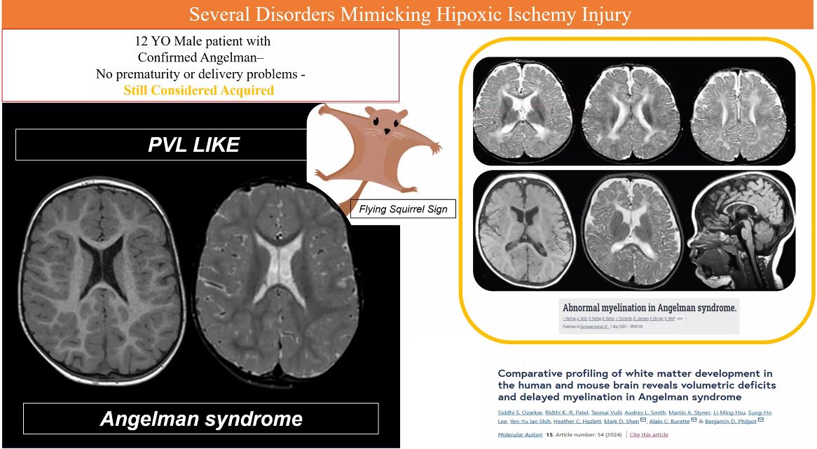 American Society of Pediatric Neuroradiology (@the_aspnr) on Twitter photo Neuroimaging & Neuroclinical Practices in Metabolic Disorders - CME Webinar
Neuroimaging can be helpful or may be misleading, be careful not to overestimate or underestimate the role of neuroimaging in evaluation of possible neurometabolic disorders!
<a href="/cesaralvesneuro/">CESAR ALVES</a> Neuroimaging & Neuroclinical Practices in Metabolic Disorders - CME Webinar
Neuroimaging can be helpful or may be misleading, be careful not to overestimate or underestimate the role of neuroimaging in evaluation of possible neurometabolic disorders!
<a href="/cesaralvesneuro/">CESAR ALVES</a>