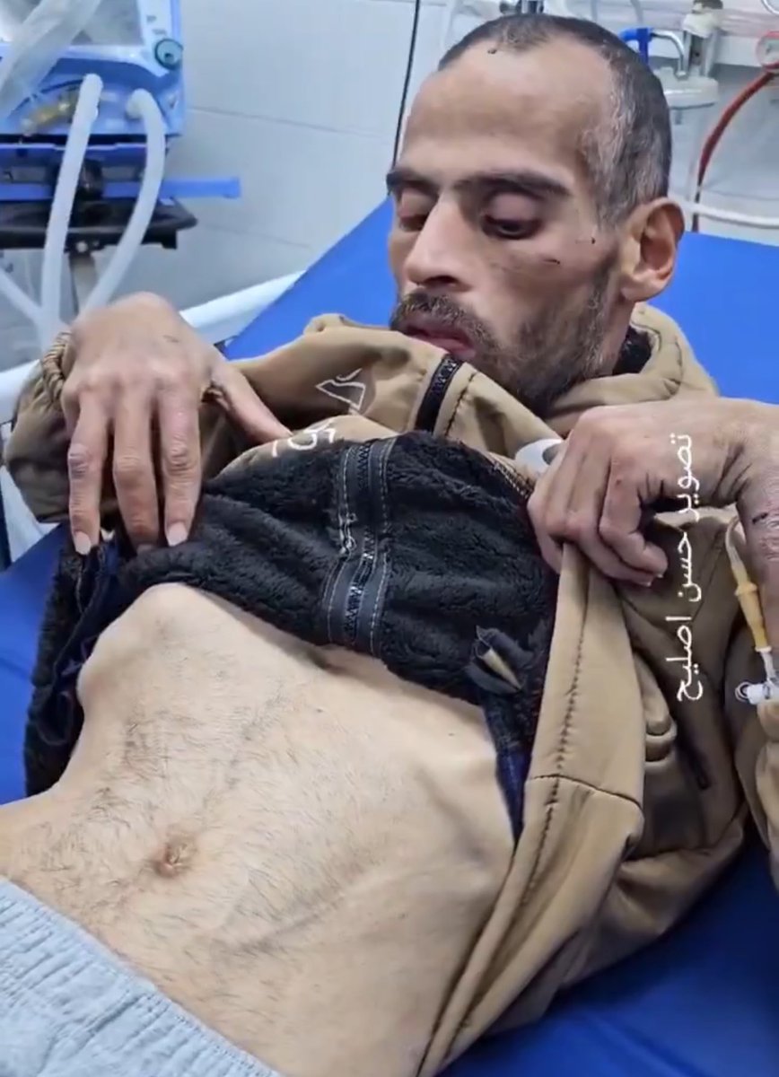 AssalRad's tweet image. Where is the wall-to-wall coverage on the gaunt and tortured Palestinians released today? 

One of them with a missing leg.