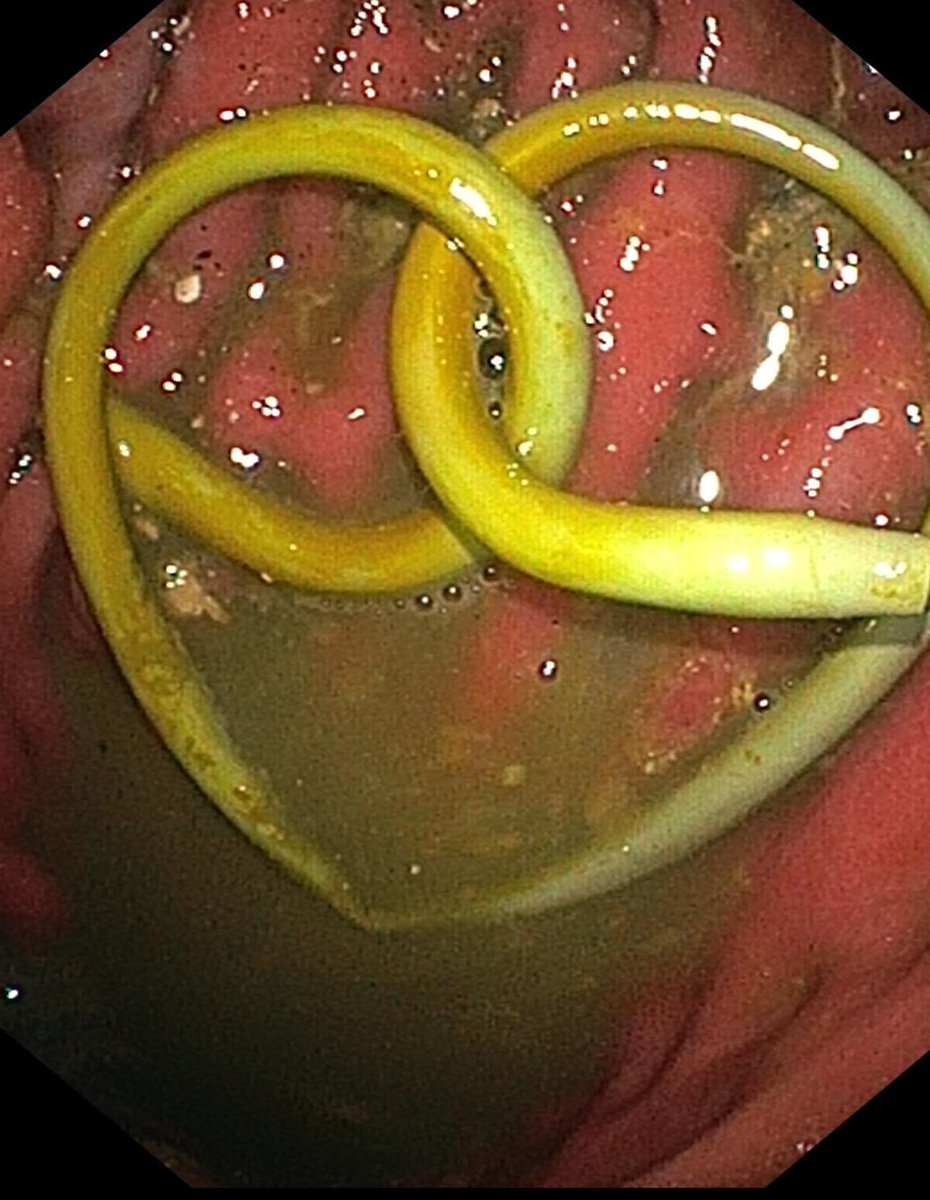 Suprabhat Giri (@giri_gutnliver) on Twitter photo Endoscopist style of wishing happy valentine's day 😂
<a href="/drsridhars/">Sridhar Sundaram MD, DM, FISG</a> <a href="/docdhir/">vinay dhir</a> <a href="/DrLakhtakia/">Sundeep Lakhtakia</a> <a href="/drkeithsiau/">Keith Siau</a> <a href="/doctorboletoh/">Shamsher Chauhan</a> <a href="/drpreetamnath/">TheTummyDoc</a> Endoscopist style of wishing happy valentine's day 😂
<a href="/drsridhars/">Sridhar Sundaram MD, DM, FISG</a> <a href="/docdhir/">vinay dhir</a> <a href="/DrLakhtakia/">Sundeep Lakhtakia</a> <a href="/drkeithsiau/">Keith Siau</a> <a href="/doctorboletoh/">Shamsher Chauhan</a> <a href="/drpreetamnath/">TheTummyDoc</a>