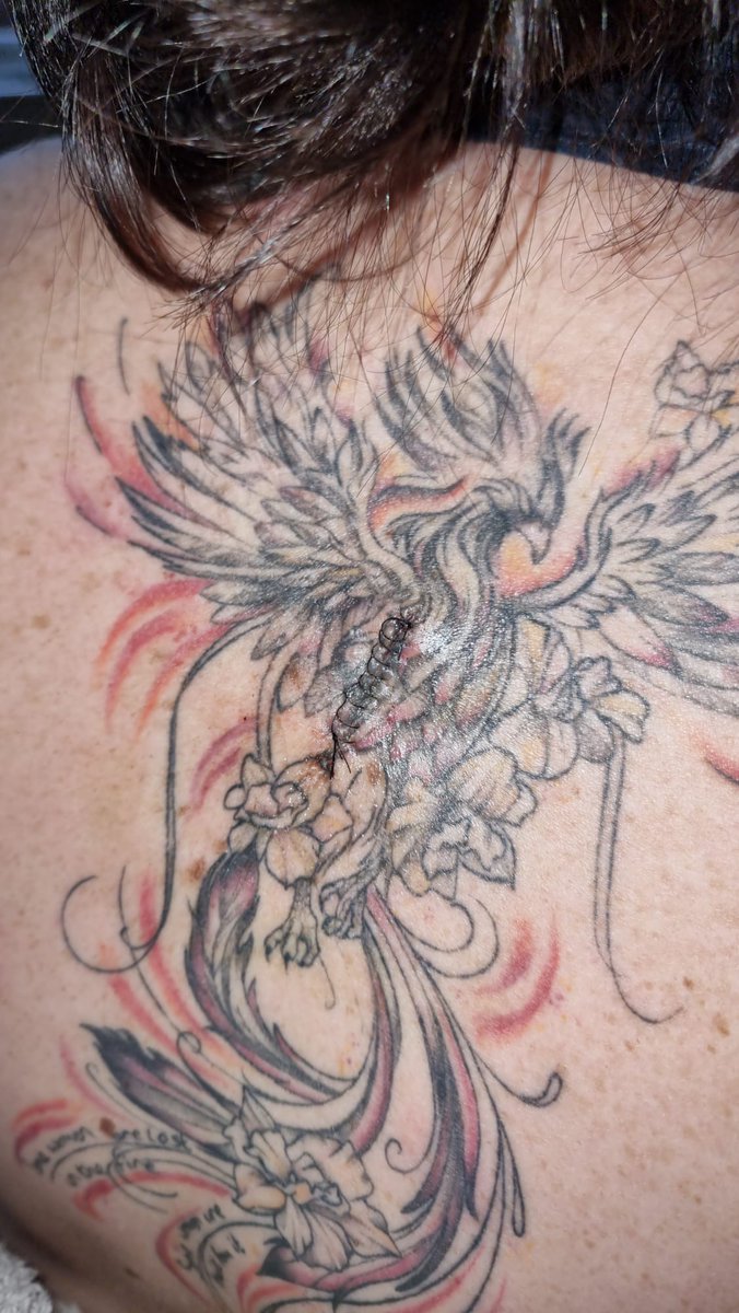 Another mole that had melanoma removed. They've done a beautiful job at healing my tattoo back together! Thank u <a href="/AneurinBevanUHB/">Aneurin Bevan University Health Board</a> for 2 swift identification and treatments within 3 months of these. Be sure to check yourself and see a doctor if you're unsure #wearSuncream